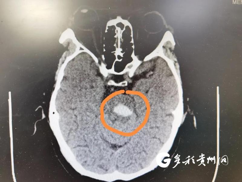 脑干出血症状图片