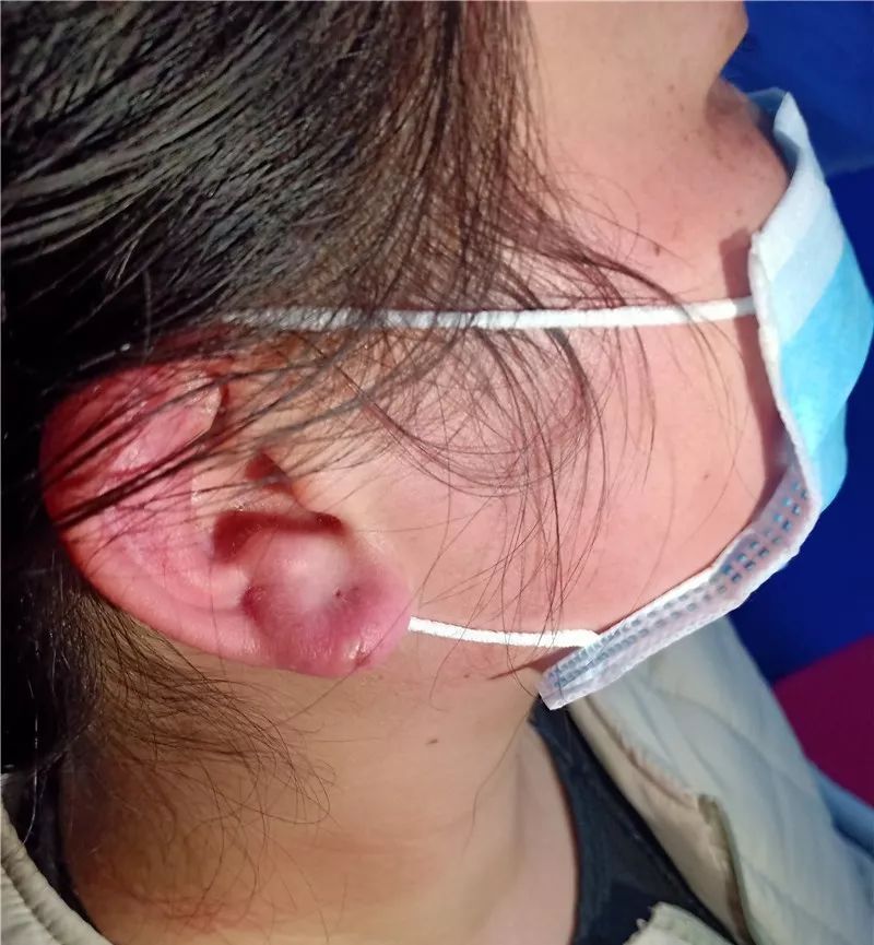 耳朵冻疮图片治疗方法图片