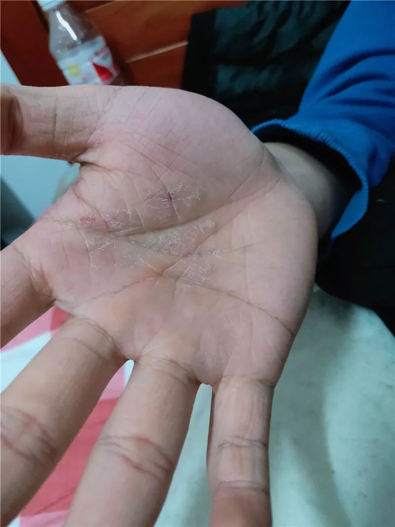 他们有的脸上被口罩勒出了印痕,      有的手掌开裂,有的耳朵被冻 